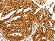 The image on the left is immunohistochemistry of paraffin-embedded Human ovarian cancer tissue using CSB-PA592469(PDCD6 Antibody) at dilution 1/25, on the right is treated with fusion protein. (Original magnification: ×200)
