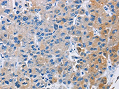 The image on the left is immunohistochemistry of paraffin-embedded Human liver cancer tissue using CSB-PA592611(CARD14 Antibody) at dilution 1/30, on the right is treated with fusion protein. (Original magnification: ×200)