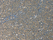 The image on the left is immunohistochemistry of paraffin-embedded Human lymphoma tissue using CSB-PA592707(IL27 Antibody) at dilution 1/10, on the right is treated with fusion protein. (Original magnification: ×200)