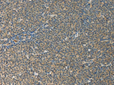 The image on the left is immunohistochemistry of paraffin-embedded Human lymphoma tissue using CSB-PA592707(IL27 Antibody) at dilution 1/10, on the right is treated with fusion protein. (Original magnification: ×200)