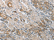 The image on the left is immunohistochemistry of paraffin-embedded Human gastic cancer tissue using CSB-PA592744(CST3 Antibody) at dilution 1/50, on the right is treated with synthetic peptide. (Original magnification: ×200)