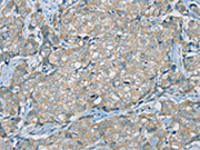 The image on the left is immunohistochemistry of paraffin-embedded Human breast cancer tissue using CSB-PA593030(SERPINA11 Antibody) at dilution 1/35, on the right is treated with synthetic peptide. (Original magnification: ×200)