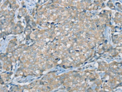 The image on the left is immunohistochemistry of paraffin-embedded Human breast cancer tissue using CSB-PA593030(SERPINA11 Antibody) at dilution 1/35, on the right is treated with synthetic peptide. (Original magnification: ×200)