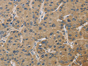 The image on the left is immunohistochemistry of paraffin-embedded Human liver cancer tissue using CSB-PA593332(TBXAS1 Antibody) at dilution 1/30, on the right is treated with fusion protein. (Original magnification: ×200)