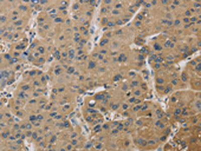 The image on the left is immunohistochemistry of paraffin-embedded Human liver cancer tissue using CSB-PA593332(TBXAS1 Antibody) at dilution 1/30, on the right is treated with fusion protein. (Original magnification: ×200)