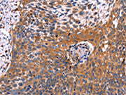 The image on the left is immunohistochemistry of paraffin-embedded Human cervical cancer tissue using CSB-PA593723(RDX Antibody) at dilution 1/60, on the right is treated with fusion protein. (Original magnification: ×200)
