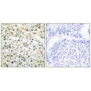 Immunohistochemistry analysis of paraffin-embedded human liver carcinoma tissue using DNMT3B antibody.