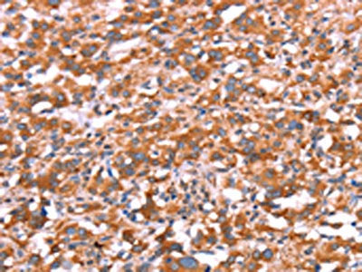 The image on the left is immunohistochemistry of paraffin-embedded Human thyroid cancer tissue using CSB-PA593948(GAS8 Antibody) at dilution 1/30, on the right is treated with synthetic peptide. (Original magnification: ×200)