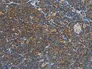 The image on the left is immunohistochemistry of paraffin-embedded Human Lymphoma tissue using CSB-PA594088(VTCN1 Antibody) at dilution 1/30, on the right is treated with fusion protein. (Original magnification: ×200)