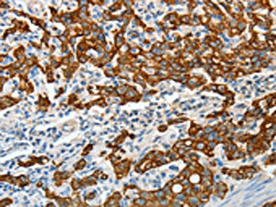 The image on the left is immunohistochemistry of paraffin-embedded Human gastric cancer tissue using CSB-PA594188(KRT18 Antibody) at dilution 1/50, on the right is treated with fusion protein. (Original magnification: X200)