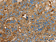 The image on the left is immunohistochemistry of paraffin-embedded Human breast cancer tissue using CSB-PA594413(LGALS3BP Antibody) at dilution 1/25, on the right is treated with fusion protein. (Original magnification: ×200)