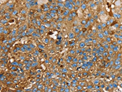 The image on the left is immunohistochemistry of paraffin-embedded Human breast cancer tissue using CSB-PA594413(LGALS3BP Antibody) at dilution 1/25, on the right is treated with fusion protein. (Original magnification: ×200)
