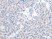 The image on the left is immunohistochemistry of paraffin-embedded Human liver cancer tissue using CSB-PA594444(GCK Antibody) at dilution 1/20, on the right is treated with synthetic peptide. (Original magnification: ×200)