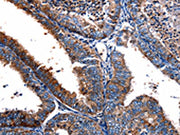 The image on the left is immunohistochemistry of paraffin-embedded Human cervical cancer tissue using CSB-PA594474(FPR2 Antibody) at dilution 1/17, on the right is treated with synthetic peptide. (Original magnification: ×200)