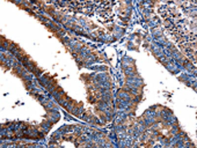 The image on the left is immunohistochemistry of paraffin-embedded Human cervical cancer tissue using CSB-PA594474(FPR2 Antibody) at dilution 1/17, on the right is treated with synthetic peptide. (Original magnification: ×200)