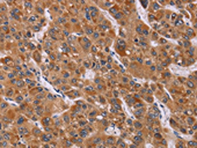 The image on the left is immunohistochemistry of paraffin-embedded Human liver cancer tissue using CSB-PA594619(CALCA Antibody) at dilution 1/40, on the right is treated with synthetic peptide. (Original magnification: ×200)