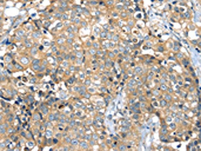 The image on the left is immunohistochemistry of paraffin-embedded Human breast cancer tissue using CSB-PA594626(MAGEA11 Antibody) at dilution 1/35, on the right is treated with synthetic peptide. (Original magnification: ×200)