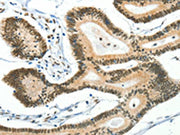 The image on the left is immunohistochemistry of paraffin-embedded Human colon cancer tissue using CSB-PA594692(BCAS2 Antibody) at dilution 1/50, on the right is treated with fusion protein. (Original magnification: ×200)