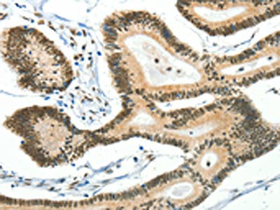 The image on the left is immunohistochemistry of paraffin-embedded Human colon cancer tissue using CSB-PA594692(BCAS2 Antibody) at dilution 1/50, on the right is treated with fusion protein. (Original magnification: ×200)