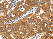 The image on the left is immunohistochemistry of paraffin-embedded Human ovarian cancer tissue using CSB-PA594760(TRAF3 Antibody) at dilution 1/40, on the right is treated with synthetic peptide. (Original magnification: ×200)