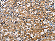 The image on the left is immunohistochemistry of paraffin-embedded Human thyroid cancer tissue using CSB-PA594945(PIKFYVE Antibody) at dilution 1/50, on the right is treated with fusion protein. (Original magnification: ×200)