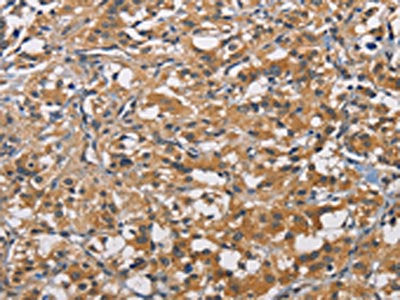 The image on the left is immunohistochemistry of paraffin-embedded Human thyroid cancer tissue using CSB-PA594945(PIKFYVE Antibody) at dilution 1/50, on the right is treated with fusion protein. (Original magnification: ×200)