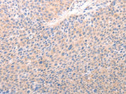 The image on the left is immunohistochemistry of paraffin-embedded Human liver cancer tissue using CSB-PA595124(ACO1 Antibody) at dilution 1/50, on the right is treated with synthetic peptide. (Original magnification: ×200)