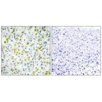 Immunohistochemistry analysis of paraffin-embedded human liver carcinoma tissue, using CHD4 antibody.