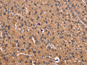 The image on the left is immunohistochemistry of paraffin-embedded Human liver cancer tissue using CSB-PA595607(CSNK1D Antibody) at dilution 1/50, on the right is treated with fusion protein. (Original magnification: ×200)