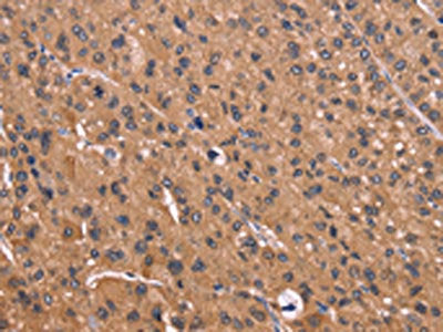 The image on the left is immunohistochemistry of paraffin-embedded Human liver cancer tissue using CSB-PA595607(CSNK1D Antibody) at dilution 1/50, on the right is treated with fusion protein. (Original magnification: ×200)