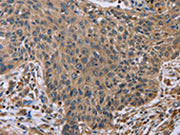 The image on the left is immunohistochemistry of paraffin-embedded Human lung cancer tissue using CSB-PA595868(EDA Antibody) at dilution 1/50, on the right is treated with fusion protein. (Original magnification: ×200)