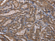 The image on the left is immunohistochemistry of paraffin-embedded Human thyroid cancer tissue using CSB-PA595985(CUL3 Antibody) at dilution 1/30, on the right is treated with fusion protein. (Original magnification: ×200)