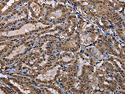 The image on the left is immunohistochemistry of paraffin-embedded Human thyroid cancer tissue using CSB-PA595985(CUL3 Antibody) at dilution 1/30, on the right is treated with fusion protein. (Original magnification: ×200)