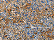 The image on the left is immunohistochemistry of paraffin-embedded Human liver cancer tissue using CSB-PA596009(HTRA3 Antibody) at dilution 1/45, on the right is treated with synthetic peptide. (Original magnification: ×200)