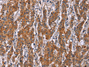 The image on the left is immunohistochemistry of paraffin-embedded Human gastic cancer tissue using CSB-PA596032(ICAM3 Antibody) at dilution 1/20, on the right is treated with synthetic peptide. (Original magnification: ×200)