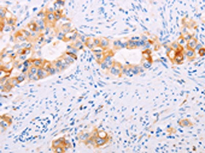 The image on the left is immunohistochemistry of paraffin-embedded Human cervical cancer tissue using CSB-PA596121(TGM2 Antibody) at dilution 1/15, on the right is treated with fusion protein. (Original magnification: ×200)