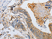 The image on the left is immunohistochemistry of paraffin-embedded Human colon cancer tissue using CSB-PA596199(SLC2A5 Antibody) at dilution 1/12, on the right is treated with synthetic peptide. (Original magnification: ×200)