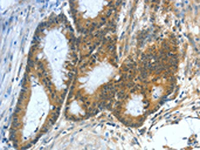The image on the left is immunohistochemistry of paraffin-embedded Human colon cancer tissue using CSB-PA596240(ASNS Antibody) at dilution 1/50, on the right is treated with fusion protein. (Original magnification: ×200)