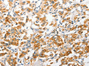 The image on the left is immunohistochemistry of paraffin-embedded Human thyroid cancer tissue using CSB-PA596504(ANAPC2 Antibody) at dilution 1/30, on the right is treated with fusion protein. (Original magnification: ×200)