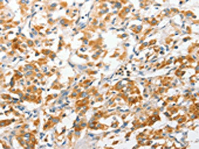 The image on the left is immunohistochemistry of paraffin-embedded Human thyroid cancer tissue using CSB-PA596504(ANAPC2 Antibody) at dilution 1/30, on the right is treated with fusion protein. (Original magnification: ×200)