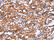 The image on the left is immunohistochemistry of paraffin-embedded Human thyroid cancer tissue using CSB-PA596695(GH1 Antibody) at dilution 1/40, on the right is treated with synthetic peptide. (Original magnification: ×200)