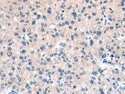The image on the left is immunohistochemistry of paraffin-embedded Human liver cancer tissue using CSB-PA596755(TTI1 Antibody) at dilution 1/40, on the right is treated with synthetic peptide. (Original magnification: ×200)