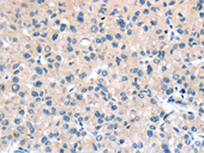 The image on the left is immunohistochemistry of paraffin-embedded Human liver cancer tissue using CSB-PA596755(TTI1 Antibody) at dilution 1/40, on the right is treated with synthetic peptide. (Original magnification: ×200)
