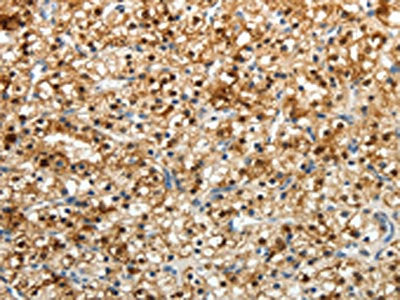 The image on the left is immunohistochemistry of paraffin-embedded Human renal cancer tissue using CSB-PA596830(FZD2 Antibody) at dilution 1/25, on the right is treated with synthetic peptide. (Original magnification: ×200)