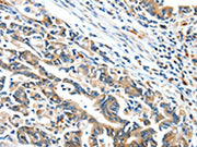 The image on the left is immunohistochemistry of paraffin-embedded Human gastic cancer tissue using CSB-PA596925(BCL2L2 Antibody) at dilution 1/15, on the right is treated with fusion protein. (Original magnification: ×200)