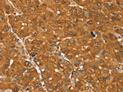 The image on the left is immunohistochemistry of paraffin-embedded Human ovarian cancer tissue using CSB-PA597067(SSTR3 Antibody) at dilution 1/30, on the right is treated with synthetic peptide. (Original magnification: ×200)