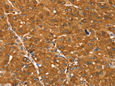 The image on the left is immunohistochemistry of paraffin-embedded Human ovarian cancer tissue using CSB-PA597067(SSTR3 Antibody) at dilution 1/30, on the right is treated with synthetic peptide. (Original magnification: ×200)