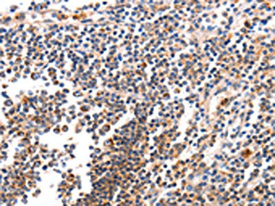The image on the left is immunohistochemistry of paraffin-embedded Human tonsil tissue using CSB-PA597282(BCL2L15 Antibody) at dilution 1/50, on the right is treated with fusion protein. (Original magnification: ×200)
