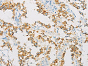 The image on the left is immunohistochemistry of paraffin-embedded Human thyroid cancer tissue using CSB-PA597290(IDH3B Antibody) at dilution 1/30, on the right is treated with fusion protein. (Original magnification: ×200)