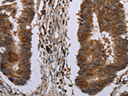 The image on the left is immunohistochemistry of paraffin-embedded Human colon cancer tissue using CSB-PA597310(MIG7 Antibody) at dilution 1/20, on the right is treated with synthetic peptide. (Original magnification: ×200)